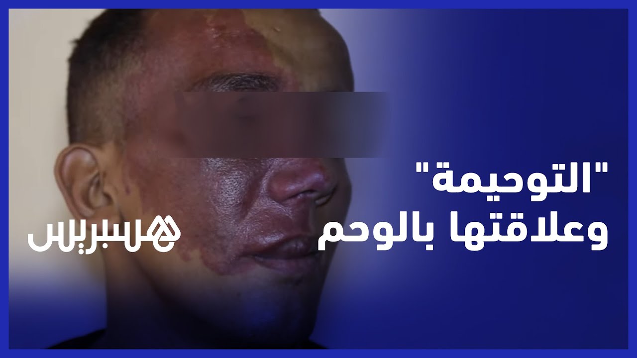 تعريف الوحمة الخلقية أو "التوحيمة" وعلاقتها بالوحم عند المرأة الحامل thumbnail