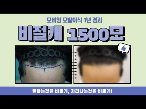 비절개 1500모 모발이식 1년 경과영상!