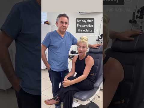 Rhinoplasty patient onial