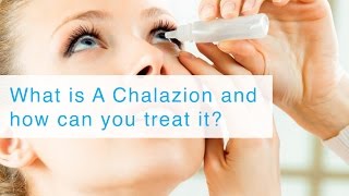 What is A Chalazion and how can you treat it?
