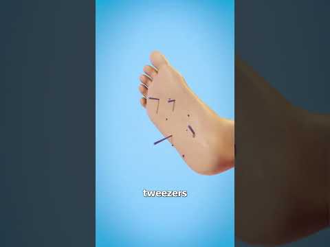 How To Remove Sea Urchin Spines 😬