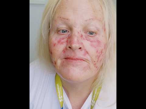 Day 18 of Efudix 5% Flourouracil treatment for Actinic Keratosis