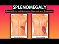 Splenomegaly Causes Signs And Symptoms Diagnosis And Treatment