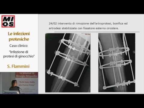 Unguento per distorsioni dellarticolazione della spalla Il trattamento della colonna vertebrale in elettronica Voronezh