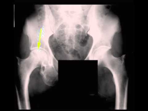 AVN Femoral Head on X ray