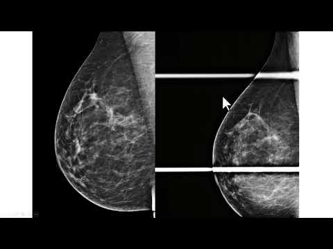 Compressão focal no perfil na avaliação de assimetria