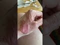 Healing Process of a Second Degree Burn