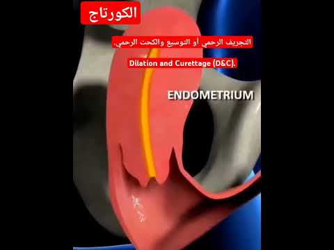 #التجريف الرحمي #الكورتاج والكحت الرحمي.Dilation and Curettage (D&C) #تنضيف-الرحم