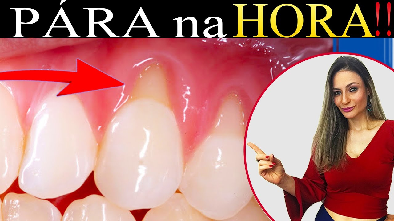 2 Killer Tips for (END FOR ONE) with Gum Retraction!!