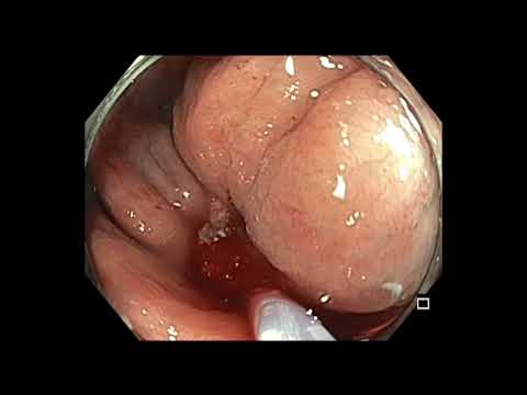 Colonoscopia: resección de pólipo atado al colon ascendente