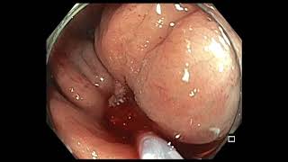 Colonoscopy: Ascending colon tethered polyp - Rese