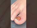 Demystifying Toenail Fungal Infections