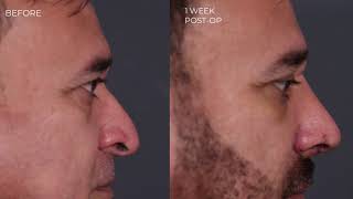 Primary Rhinoplasty with Weir Incisions with Dr. Paul Nassif
