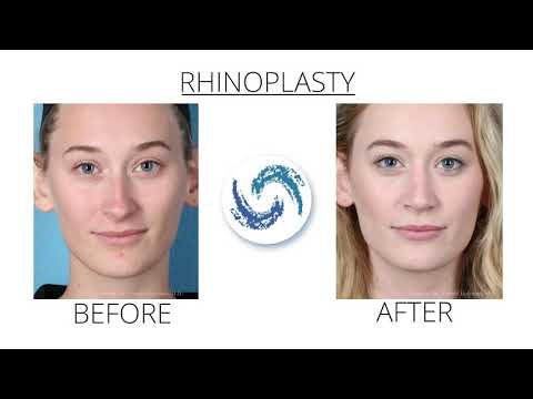 Rhinoplasty Overview | Holcomb Kreithen Plastic Surgery