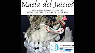 Cirujano Maxilofacial Saltillo Extracción de Muela del Juicio - Laura Gabriela González Valdez