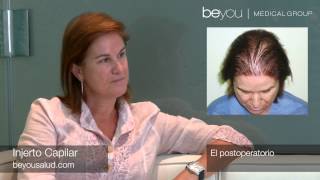 Resultados de Injerto Capilar en Mujeres, Transplante de Pelo en mujer. Beyou Medical Group HD
