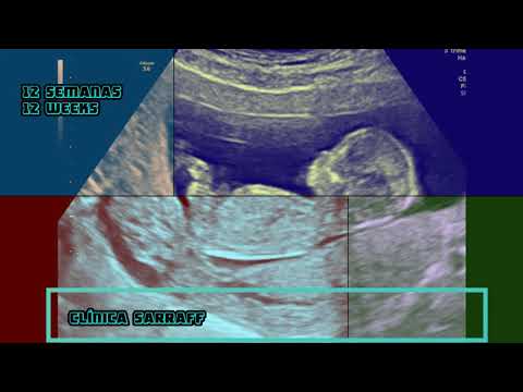 12 SEMANAS DE GESTAÇÃO - 3D 4D - CLÍNICA SARRAFF CURITIBA - ECOGRAFIA CURITIBA
