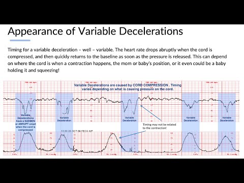 Fetal Monitoring Part 4: Understanding Variable Decelerations