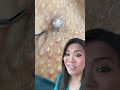 We call this a “collision pop”  An ingrown hair next to a comedone 💥