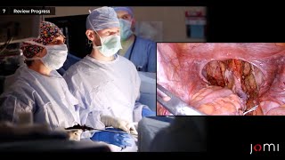Download Lagu Laparoscopic Suture Rectopexy, Culdoplasty, Vaginal Wall Repair, and Perineorrhaphy- Rectal Prolapse Thumbnail