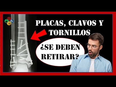 LET ME TELL YOU: Are plates and screws removed in a FRACTURE?