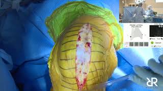 Dr. Stefan Kreuzer performs Total Knee Arthroplasty Using @IntellijointSurgical