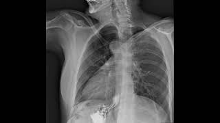 Dynamic Digital Radiography Demo - Retrospective Abdomen movement | Konica Minolta Healthcare