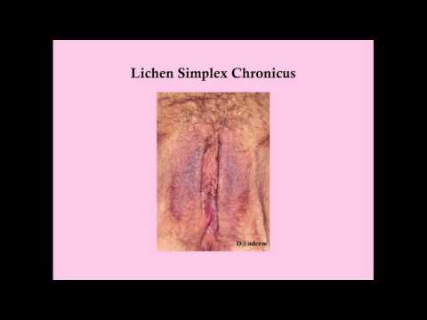 Testicular cancer which lymph nodes
