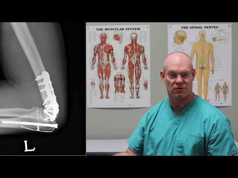 Distal Humerus Fracture | Fracture Friday Episode 39