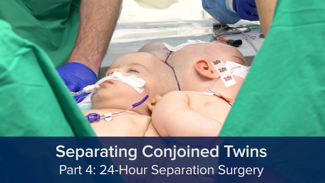 Separating Conjoined Twins Part 4 - 24-Hour Separation Surgery (surgery images blurred)