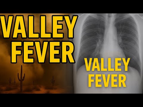 Valley Fever (Coccidioidomycosis) – Causes, Symptoms, Diagnosis & Treatment | DrPKLyfe