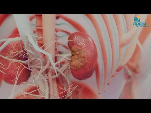 Antenatal to Postnatal Hydronephrosis Care | Dr. Balamourougane P | Apollo Hospitals