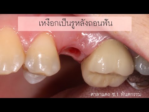 ยาต้านการเสื่อมสมรรถภาพทางเพศที่ดี ค้อนของ ธ อร์กับซากเรือเก่า ๆ