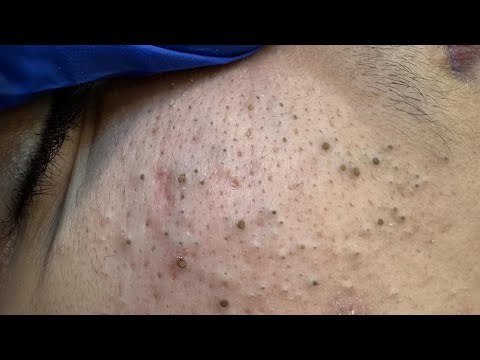 [ASMR] Blackhead Removal and Deep Pore Cleansing for Glowing Skin