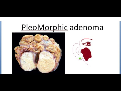 pleomorf adenoma kezelése)