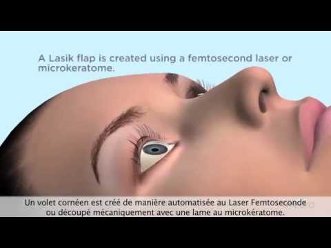 Technique du LASIK Xtra - Animation explicative