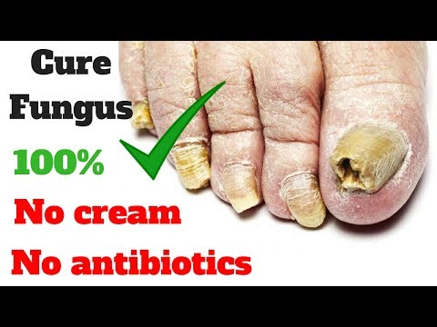 Cream sa paa halamang-singaw Lunas para sa mga halamang-singaw toe mga review ng kuko