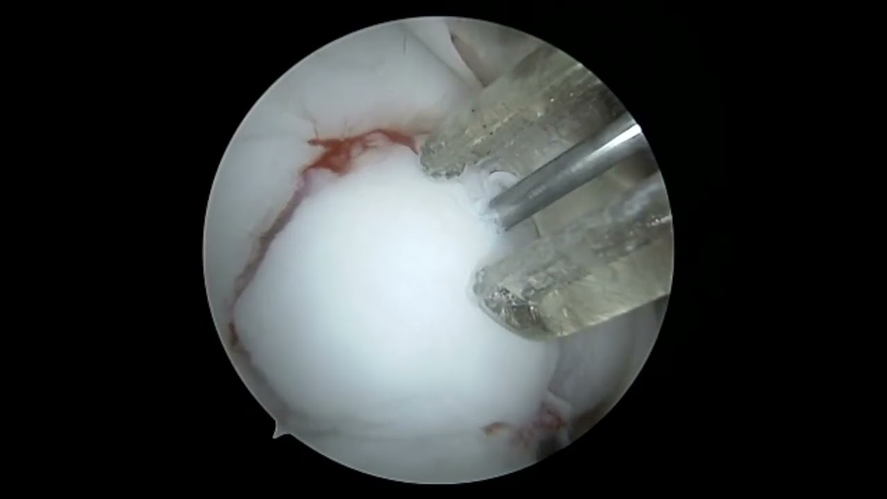 MFC OCD repair with absorbable screws