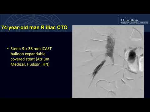 Use of the Ocelot Catheter in Iliac CTO Intervention - Daniel Walters, MD