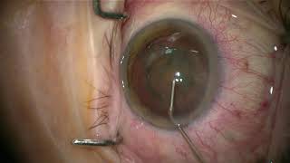 Phacoemulsification cataract surgery