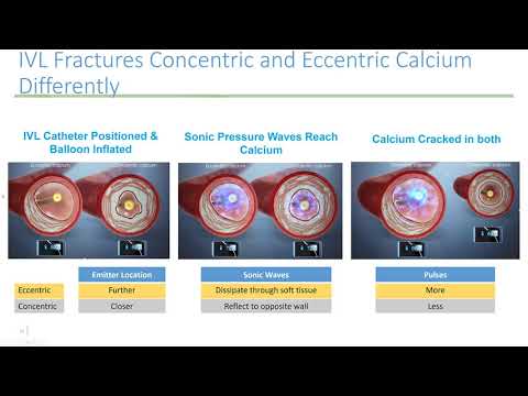 Coronary lithoplasty: Step-by-step - Nicholas Burke, MD