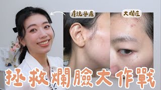 谷底爛肌起死回生/五樣好物拯救痘痘粉刺/消除痘疤皮膚亮白最強精華！超強Panasonic SR86美容儀救了我 #美容儀 #panasonic