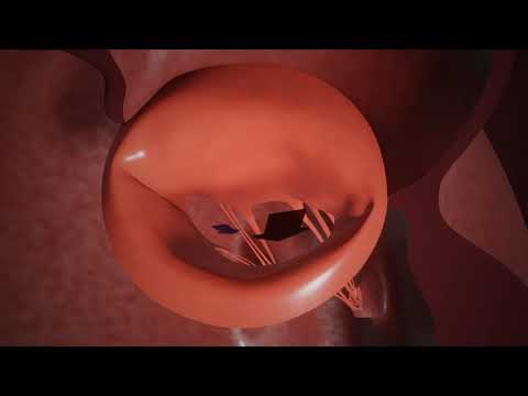 MitraClip mitral heart valve repair