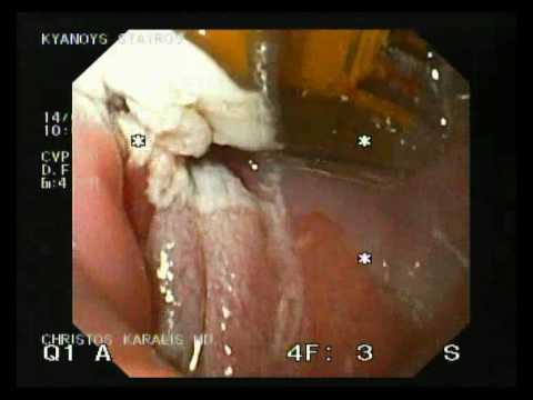 Barrett-Ösophagus - endoskopische Therapie mittels Halo 90