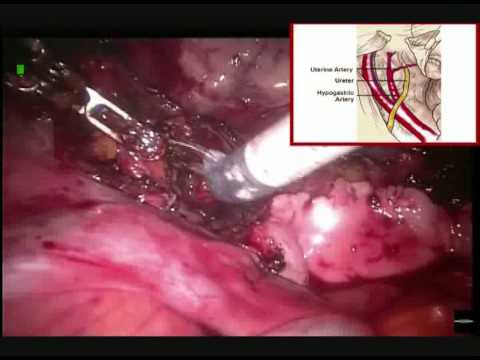 Cervicectomy Fertility-Saving And Both Sides Pelvic Lymph Nodes Excision With A Robotic Method