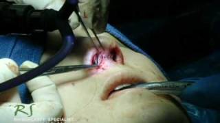OR Video Footage: Closing Rhinoplasty Incisions