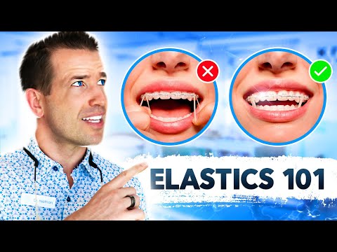 Ultimate Guide to Rubber bands | Braces Elastics