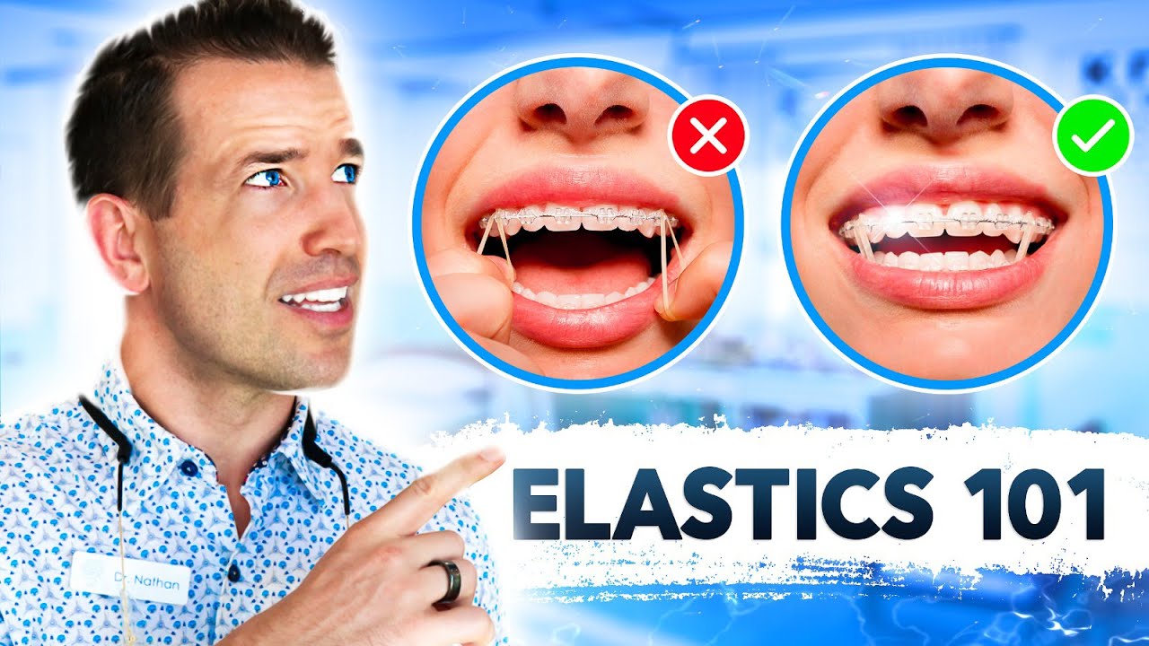 Ultimate Guide to Rubber bands | Braces Elastics