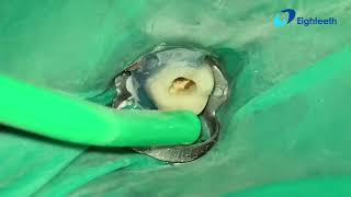 POV clinical presentation of RCT of tooth 19 from start to finish, unedited. 