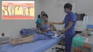 Lipoescultura Laser